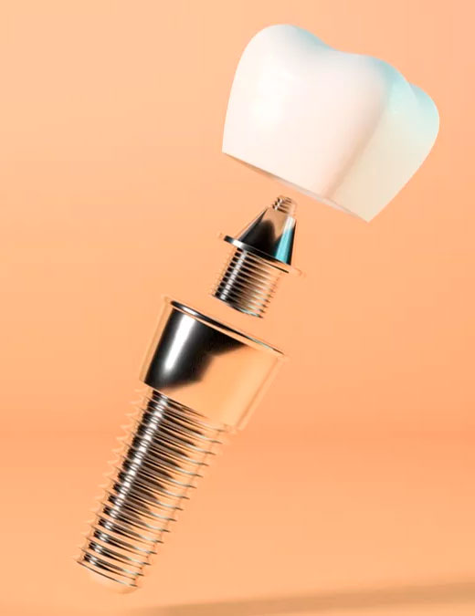 Implantes Dentales Palma de Mallorca